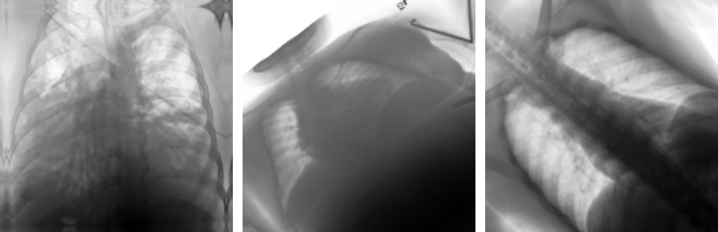 Three randomly augmented versions of a chest X-ray