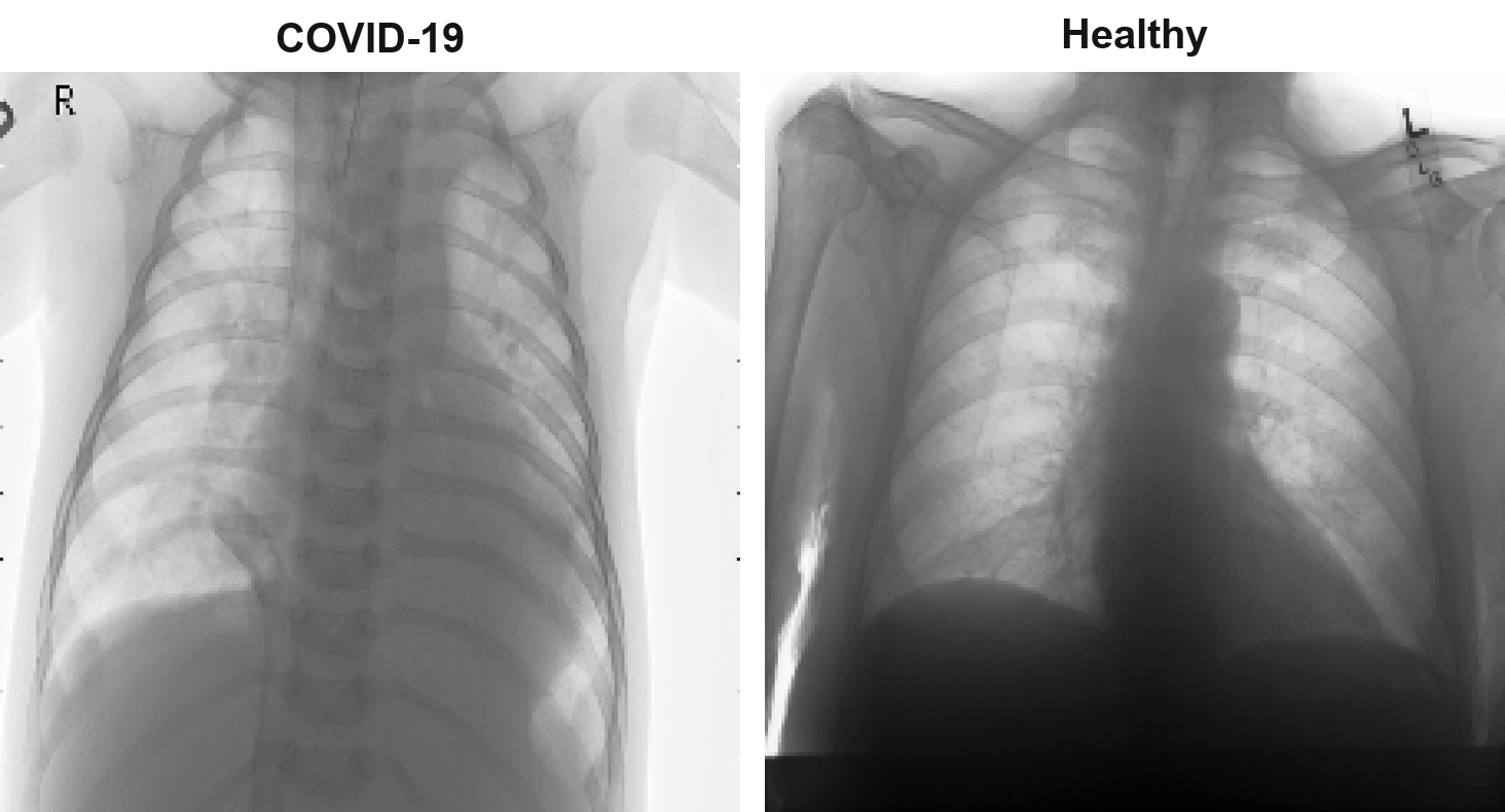 Sample chest X-rays: a COVID-19 case and a healthy case